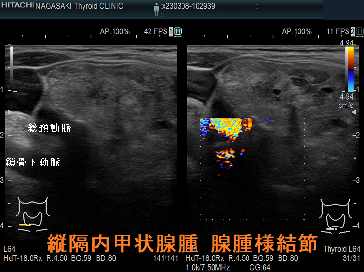 縦隔内甲状腺腫 腺腫様結節 超音波(エコー)画像 縦隔内甲状腺腫 腺腫様結節 超音波(エコー)画像