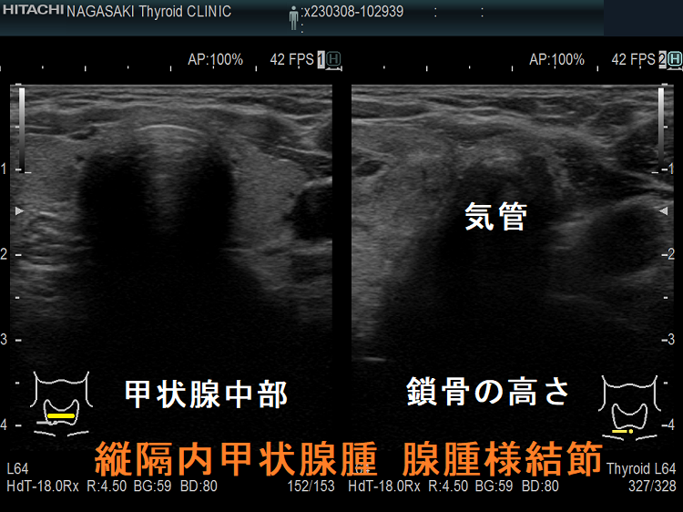 縦隔内甲状腺腫 腺腫様結節 気管圧排 縦隔内甲状腺腫 腺腫様結節 気管圧排
