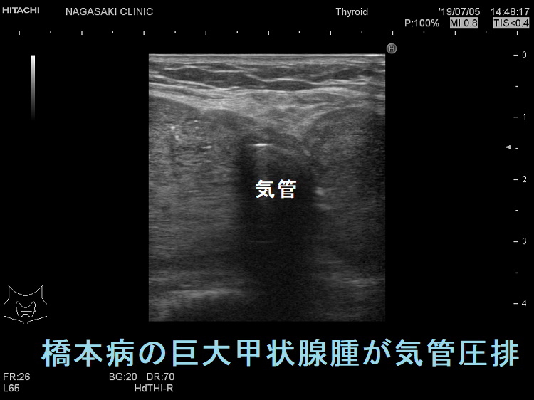 橋本病の巨大甲状腺腫が気管圧排 超音波エコー画像 橋本病の巨大甲状腺腫が気管圧排 超音波エコー画像