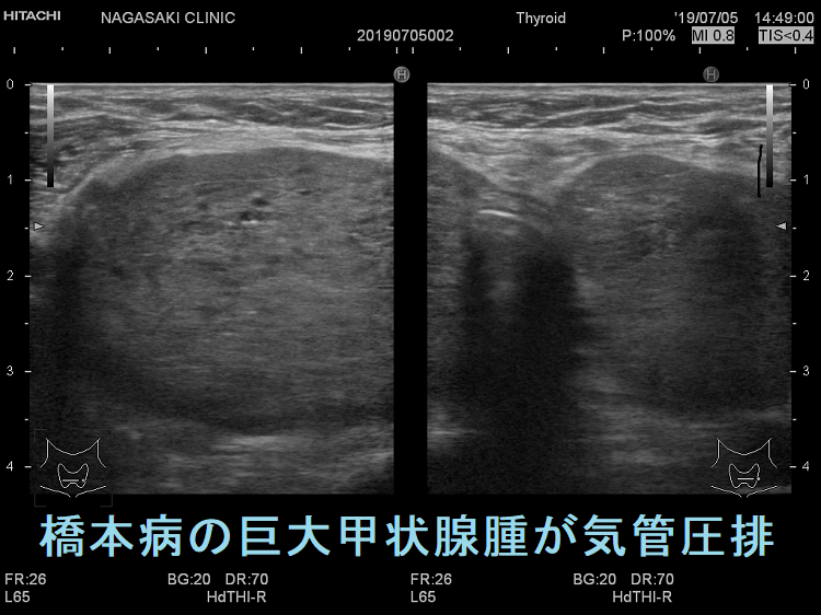 橋本病の巨大甲状腺腫が気管圧排 超音波エコー画像2 橋本病の巨大甲状腺腫が気管圧排 超音波エコー画像2