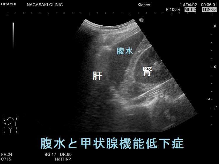 腹水と甲状腺機能低下症 超音波(エコー)画像 腹水と甲状腺機能低下症 超音波(エコー)画像