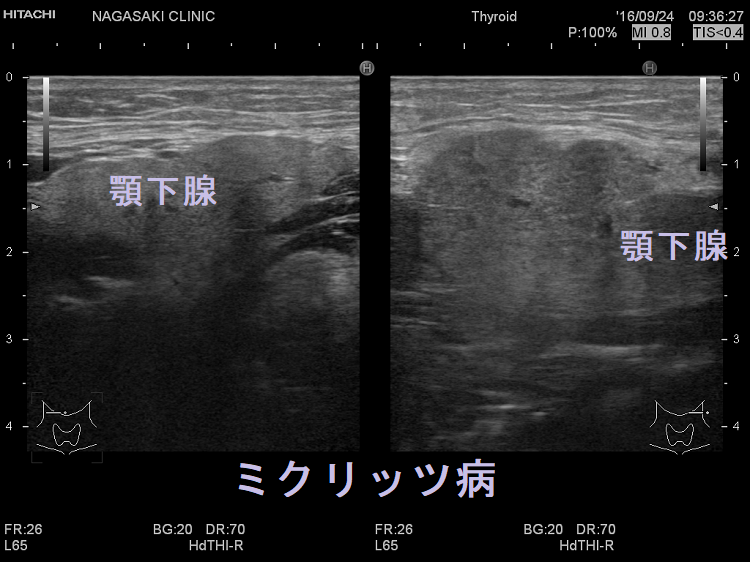 甲状腺以外のIgG4関連疾患(IgG4-RD)(眼症,ミクリッツ病,下垂体炎 甲状腺以外のIgG4関連疾患(IgG4-RD)(眼症,ミクリッツ病,下垂体炎