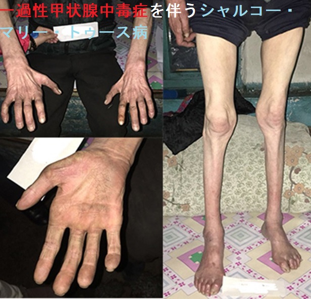 一過性甲状腺中毒症を伴うシャルコー・マリー・トゥース病 一過性甲状腺中毒症を伴うシャルコー・マリー・トゥース病