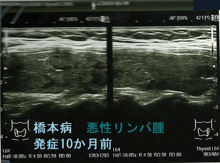 橋本病 悪性リンパ腫発症10か月前 橋本病 悪性リンパ腫発症10か月前