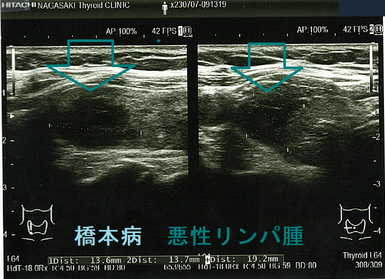橋本病 悪性リンパ腫 発症時 橋本病 悪性リンパ腫 発症時