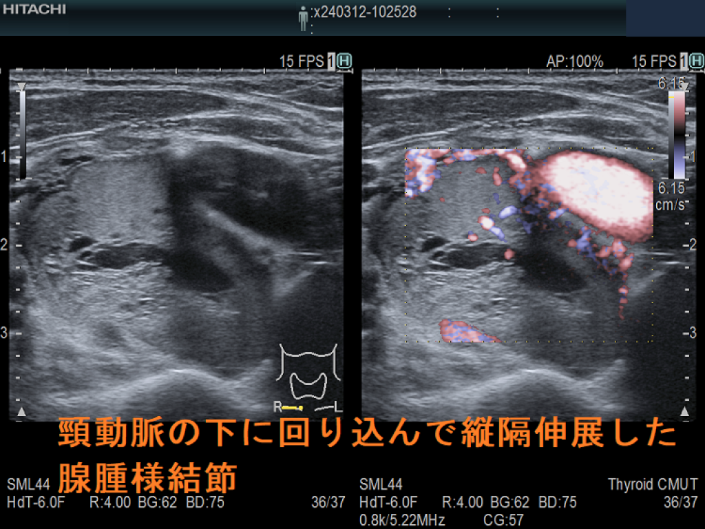 縦隔内甲状腺腫[橋本病 バセドウ病 甲状腺超音波検査エコー