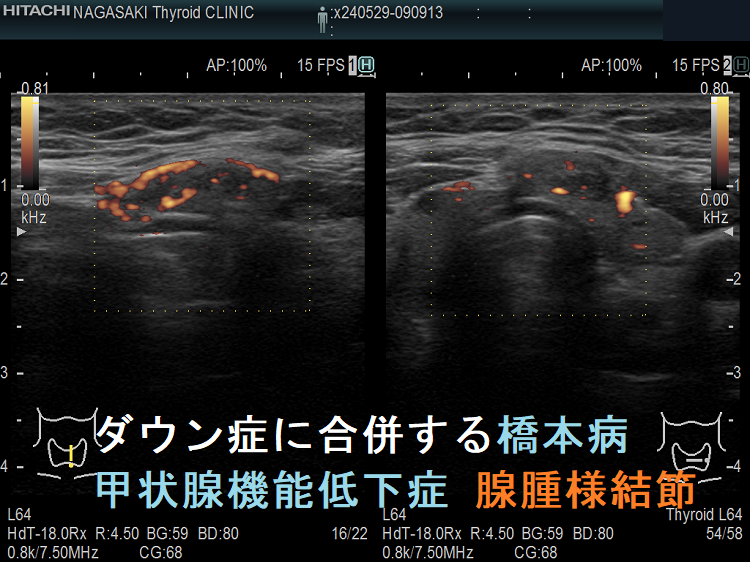 ダウン症に合併する橋本病 甲状腺機能低下症 腺腫様結節 ドプラーモード ダウン症に合併する橋本病 甲状腺機能低下症 腺腫様結節 ドプラーモード