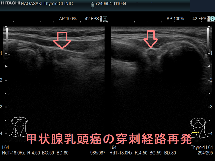 甲状腺乳頭癌の穿刺経路再発 超音波(エコー)画像 甲状腺乳頭癌の穿刺経路再発 超音波(エコー)画像