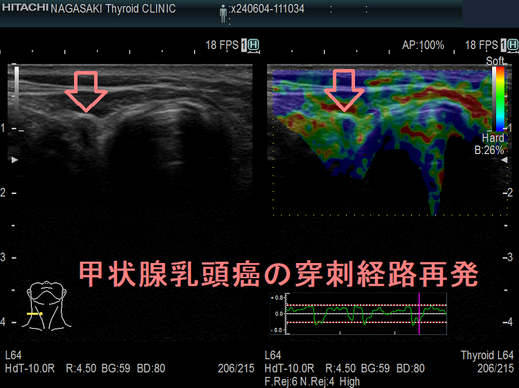 甲状腺乳頭癌の穿刺経路再発 超音波(エコー)画像 エラストグラフィー 甲状腺乳頭癌の穿刺経路再発 超音波(エコー)画像 エラストグラフィー