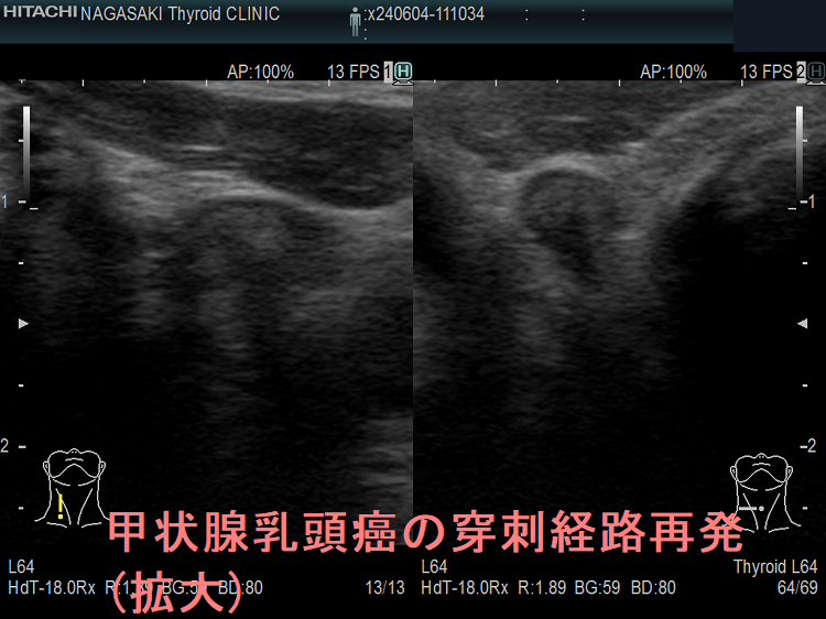 甲状腺乳頭癌の穿刺経路再発(拡大) 超音波(エコー)画像 甲状腺乳頭癌の穿刺経路再発(拡大) 超音波(エコー)画像