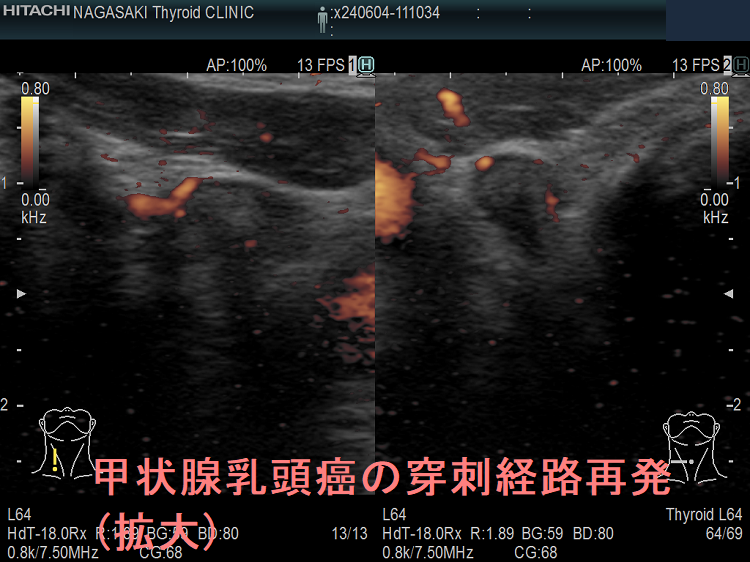 甲状腺乳頭癌の穿刺経路再発 超音波(エコー)画像(拡大) ドプラーモード 甲状腺乳頭癌の穿刺経路再発 超音波(エコー)画像(拡大) ドプラーモード