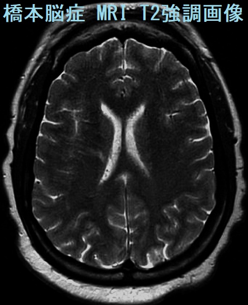 橋本脳症 MRI T2強調画像 橋本脳症 MRI T2強調画像