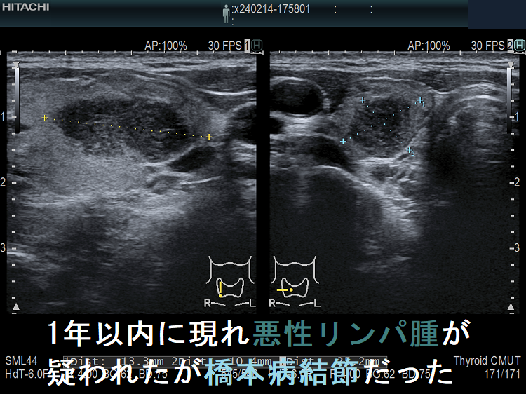 1年以内に現れ悪性リンパ腫が疑われたが橋本病結節だった 1年以内に現れ悪性リンパ腫が疑われたが橋本病結節だった