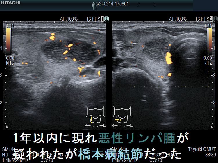 1年以内に現れ悪性リンパ腫が疑われたが橋本病結節だった ドプラーモード 1年以内に現れ悪性リンパ腫が疑われたが橋本病結節だった ドプラーモード