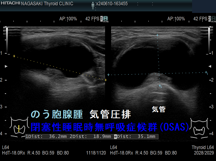 のう胞型濾胞腺腫(のう胞腺腫)気管圧排 閉塞性睡眠時無呼吸症候群(OSAS) のう胞型濾胞腺腫(のう胞腺腫)気管圧排 閉塞性睡眠時無呼吸症候群(OSAS)