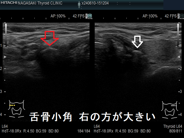 舌骨小角 右の方が大きい 舌骨小角 右の方が大きい