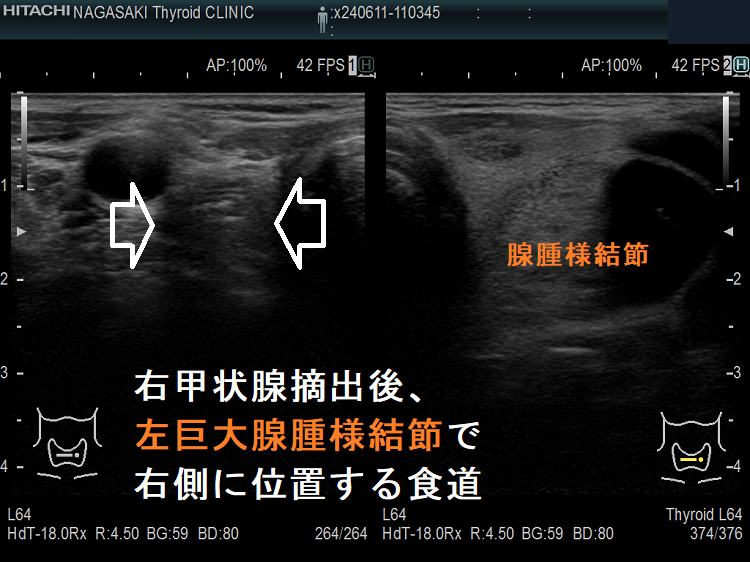 右甲状腺摘出後、左巨大腺腫様結節で右側に位置する食道 右甲状腺摘出後、左巨大腺腫様結節で右側に位置する食道