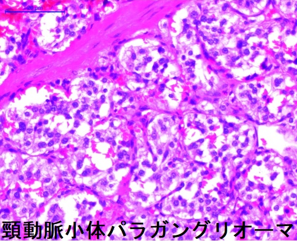 頸動脈小体パラガングリオーマ ヘマトキシリン・エオジン染色 頸動脈小体パラガングリオーマ ヘマトキシリン・エオジン染色