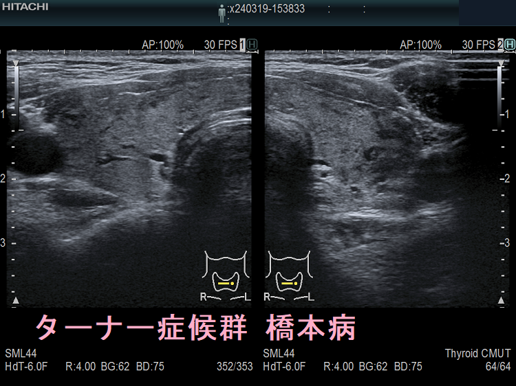 ターナー症候群 橋本病 ターナー症候群 橋本病