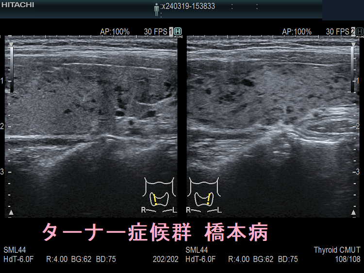ターナー症候群 橋本病 (縦断) ターナー症候群 橋本病 (縦断)