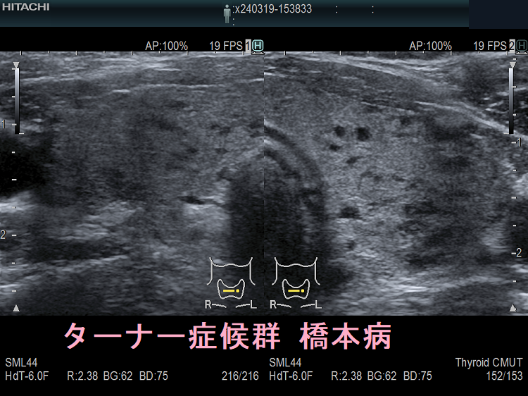 ターナー症候群 橋本病(拡大) ターナー症候群 橋本病(拡大)