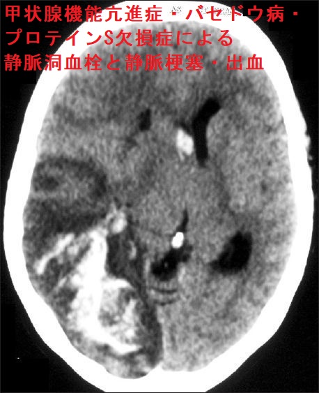 甲状腺機能亢進症・バセドウ病に合併したプロテインS欠損症による静脈洞血栓と静脈梗塞・出血 甲状腺機能亢進症・バセドウ病に合併したプロテインS欠損症による静脈洞血栓と静脈梗塞・出血