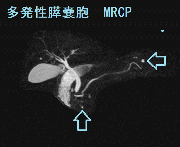 多発性膵嚢胞 MRCP画像2 多発性膵嚢胞 MRCP画像2