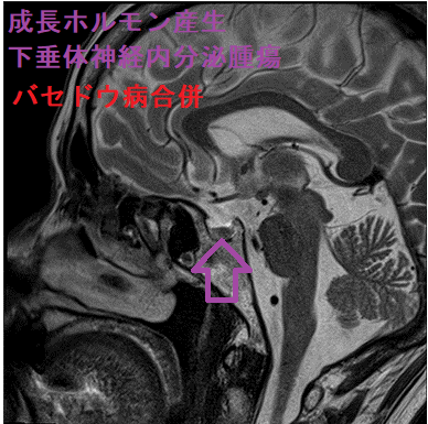 バセドウ病合併成長ホルモン産生下垂体神経内分泌腫瘍 バセドウ病合併成長ホルモン産生下垂体神経内分泌腫瘍
