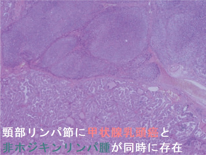 リンパ腫アトラス | 株式会社文光堂