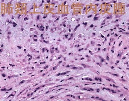 肺類上皮血管内皮腫 組織像 肺類上皮血管内皮腫 組織像