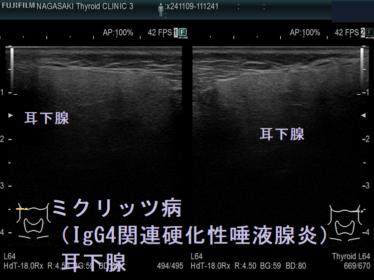 ミクリッツ病(IgG4関連硬化性唾液腺炎)耳下腺 ミクリッツ病(IgG4関連硬化性唾液腺炎)耳下腺