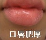 MEN 2B 口唇粘膜神経腫 MEN 2B 口唇粘膜神経腫