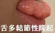 MEN 2B 口唇粘膜神経腫 MEN 2B 口唇粘膜神経腫