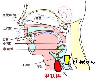 下咽頭癌の甲状腺転移 下咽頭癌の甲状腺転移