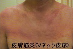 皮膚筋炎(Vネック皮疹) 皮膚筋炎(Vネック皮疹)