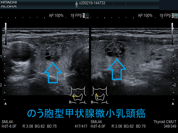 のう胞型甲状腺微小乳頭癌 被膜浸潤 超音波(エコー)画像(拡大) のう胞型甲状腺微小乳頭癌 被膜浸潤 超音波(エコー)画像(拡大)