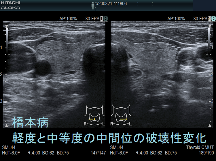 橋本病(慢性甲状腺炎):軽度と中等度の中間位の破壊 超音波(エコー)画像 橋本病(慢性甲状腺炎):軽度と中等度の中間位の破壊 超音波(エコー)画像