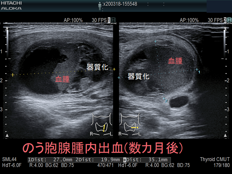 のう胞腺腫内出血(数カ月後) 超音波(エコー)画像 のう胞腺腫内出血(数カ月後) 超音波(エコー)画像
