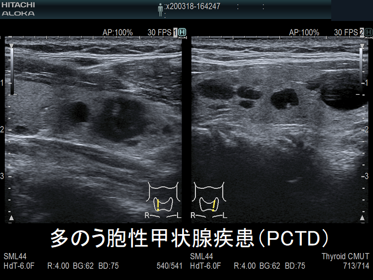 多のう胞性甲状腺疾患(PCTD) 超音波(エコー)画像 多のう胞性甲状腺疾患(PCTD) 超音波(エコー)画像