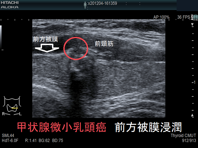 甲状腺微小乳頭癌 前方被膜浸潤 超音波(エコー)画像 甲状腺微小乳頭癌 前方被膜浸潤 超音波(エコー)画像