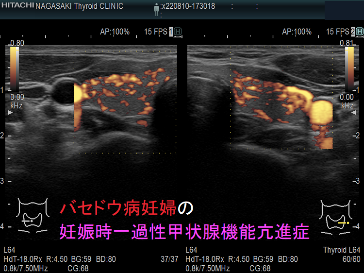 バセドウ病妊婦の 妊娠時一過性甲状腺機能亢進症 バセドウ病妊婦の妊娠時一過性甲状腺機能亢進症