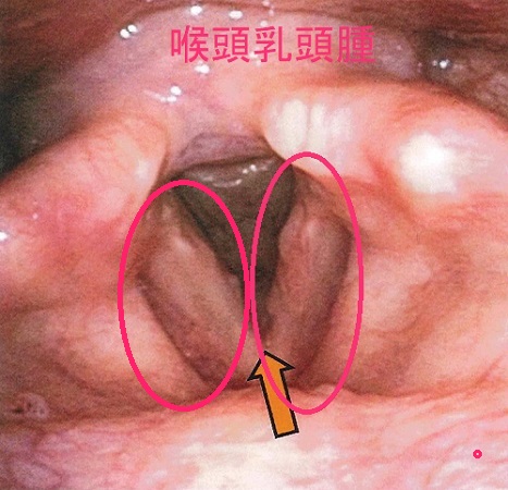 喉頭乳頭腫 喉頭乳頭腫