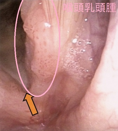 喉頭乳頭腫 喉頭乳頭腫