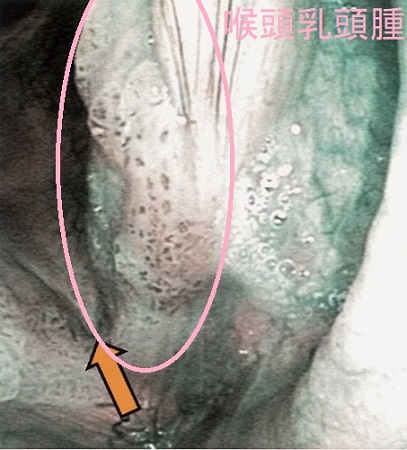 喉頭乳頭腫 喉頭乳頭腫