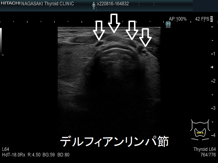 デルフィアンリンパ節 超音波(エコー)画像 デルフィアンリンパ節 超音波(エコー)画像