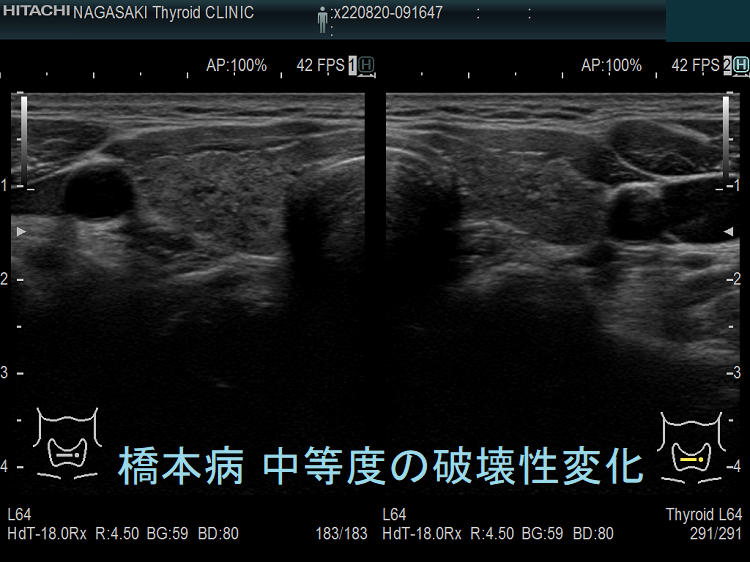 橋本病(慢性甲状腺炎):中等度の破壊 超音波(エコー)画像 橋本病(慢性甲状腺炎):中等度の破壊 超音波(エコー)画像