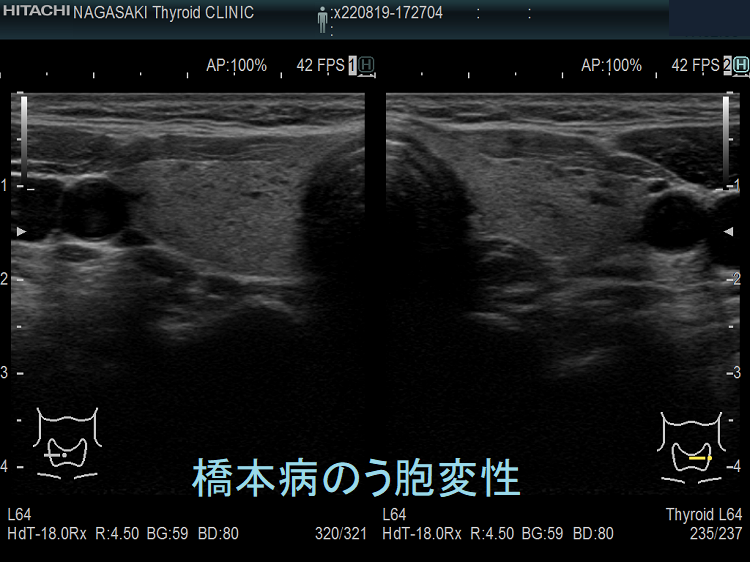 橋本病のう胞変性 超音波(エコー)画像 橋本病のう胞変性 超音波(エコー)画像