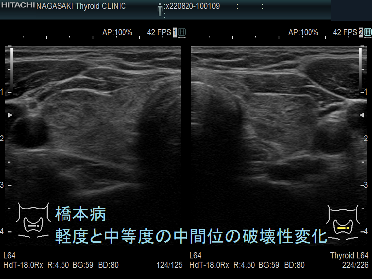 橋本病(慢性甲状腺炎):軽度と中等度の中間位の破壊 超音波(エコー)画像 橋本病(慢性甲状腺炎):軽度と中等度の中間位の破壊 超音波(エコー)画像
