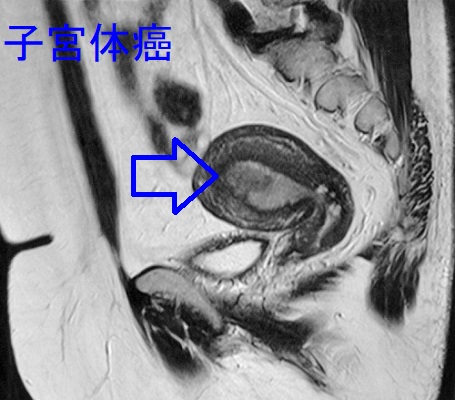 子宮内膜がん(子宮体癌) MRI T2強調画像 子宮内膜がん(子宮体癌) MRI T2強調画像