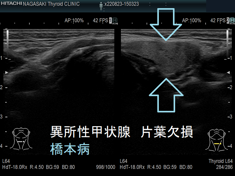 異所性甲状腺・片葉欠損症(半葉欠損症)・橋本病の合併(水平断) 異所性甲状腺・片葉欠損症(半葉欠損症)・橋本病の合併(水平断)